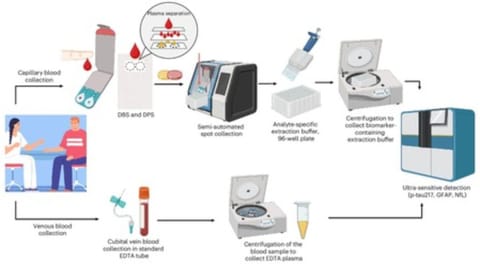Blood test can detect key biomarkers of Alzheimer