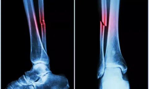 Bone Fracture Illustration (IANS)