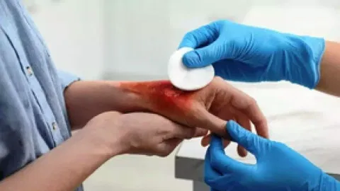 Person getting treated for the burn injury 
