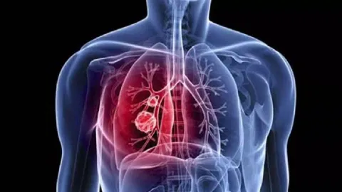 Representative Image of lung cancer 