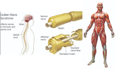 Guillain-Barre Syndrome