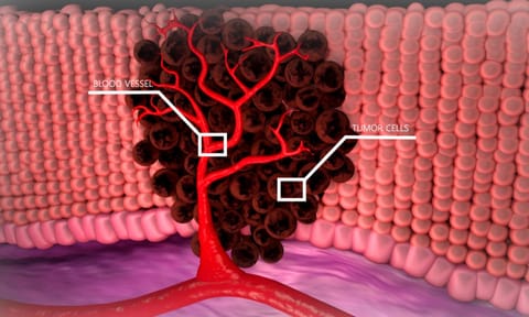 Representative Image of blood cancer 