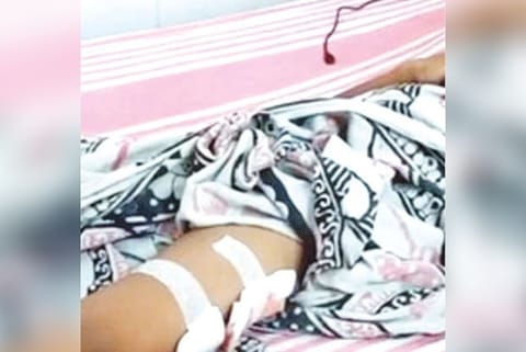 Injuries on boy bitten by street dogs in Tirupur on Friday