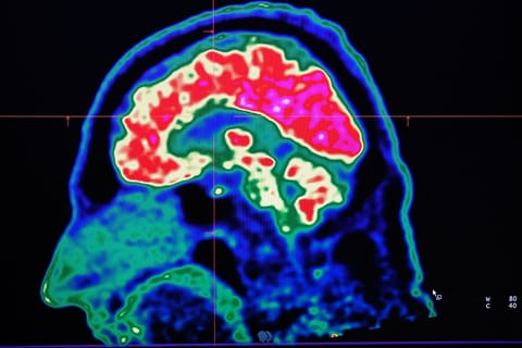 If validated in larger studies, the blood test could open the door to earlier intervention, a critical factor given that treatments are thought to be most effective before significant brain damage has occurred.