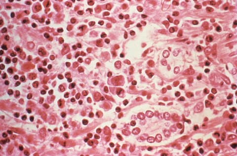 This 1994 handout photo from the US Centers for Disease Control and Prevention (CDC) obtained on May 6, 2026, shows a photograph taken through a microscope of a liver tissue specimen that was extracted from a hantavirus pulmonary syndrome (HPS) patient.