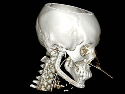 PRIME Hospital performs complex 12-hour 3D-guided jaw reconstruction