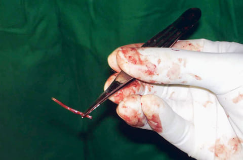 Doctors in the Iraqi city of Sulaymaniyah successfully removed 24 sharp objects from a man's stomach. Picture for illustrative purposes only.