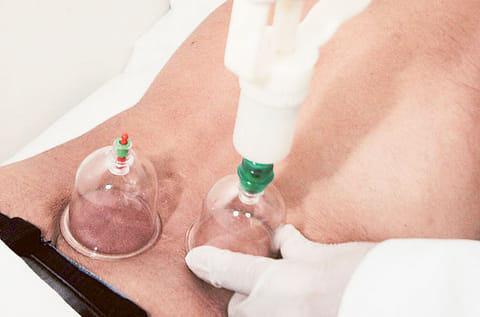 Cupping. For illustrative purposes only.