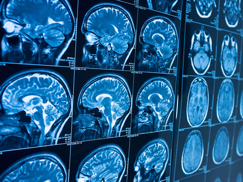 Dr Jacques Grill, a physician-researcher responsible since 2011 for the Brain Tumour Programme in the Department of Child and Teenage Oncology at Gustave Rouss, remembers having to tell Lucas's parents the difficult news that their son was going to die. Picture used for illustrative purpose only.