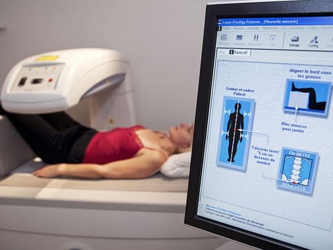 Osteoporosis is not an old age problem