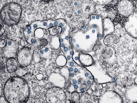 This handout illustration image courtesy of the Centers for Disease Control and Prevention (CDC) shows a transmission electron microscopic image of an isolate from the first US case of COVID-19 with the spherical viral particles, colorized blue, containing cross-sections through the viral genome, seen as black dots.
