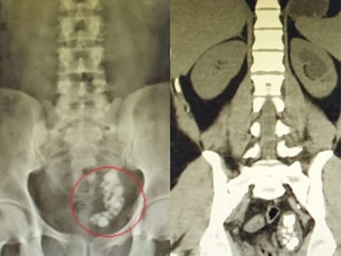 An Indian expatriate in Abu Dhabi, who had nearly 40 stones blocking his ureter, has had the obstruction removed without a single incision.