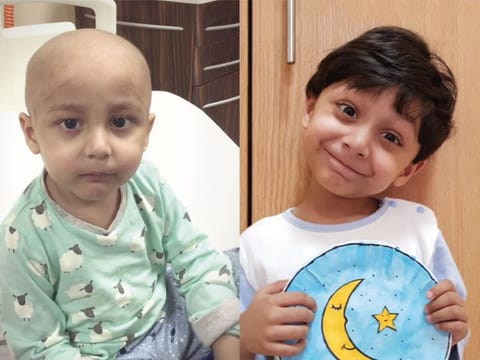 Six-year-old boy Mohammad Samar, before (left) and after the full treatment procedure.