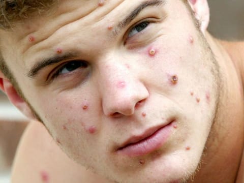 High school student Julian Glenn was believed to have contracted the monkeypox virus from his pet prairie dog, John, in this file photo taken in 2003.