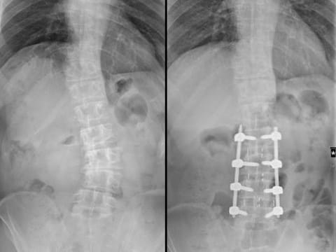 Combo X-ray image showing the curved spine (left) and how it was straightened (right) after the surgery