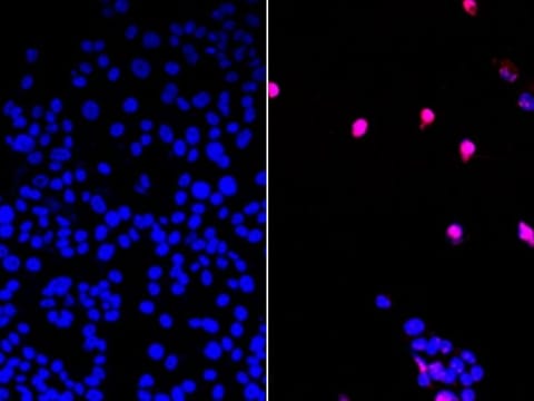 On the left side are untreated cancer cells, while on the right side, cells treated with the new drug can be observed.