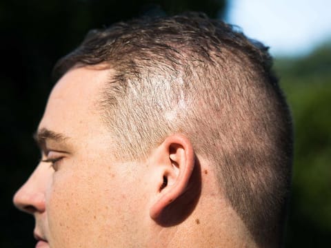 Ian Burkhart shows a scar above his ear from a previous brain implant that he had removed which helped him control his hand in Columbus, Ohio