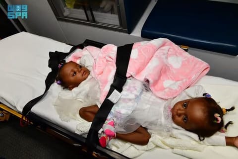 Hassana and Hasina before their separtion.