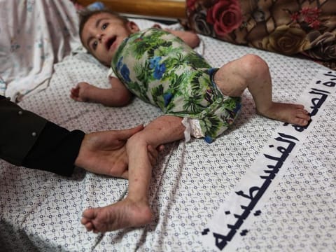 Palestinian baby girl Wateen Al Adasi who developed a skin condition due to malnutrition rests at the Kamal Adwan hospital in Beit Lahia in the northern Gaza Strip on July 2, 2024.