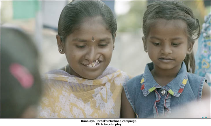 Cleft patient Jyothi smiles for the first time with Himalaya Lip Care