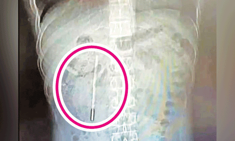 20 ஆண்டுகளாக வாலிபரின் வயிற்றுக்குள் இருந்த ‘தெர்மோ மீட்டர்’ அகற்றம்
