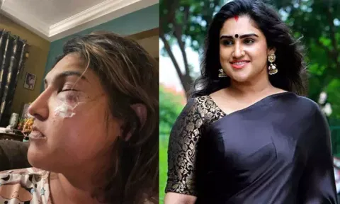 மர்மநபர் தாக்கியதாக குற்றச்சாட்டு - காயத்துடன் புகைப்படம் வெளியிட்ட வனிதா விஜயகுமார்