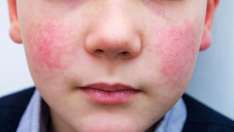 Representative Image for Common parvovirus B19 