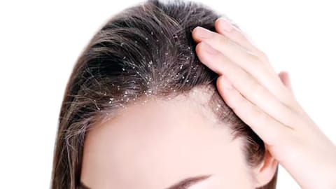 Dandruff are more common than ever, affecting millions across India. 