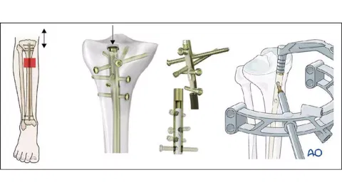 The nailing procedure