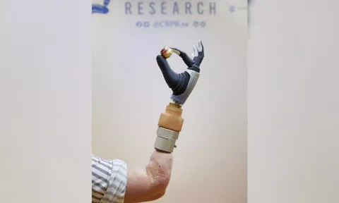 Bionic hand, merged with woman's nervous & skeletal systems, functional after years