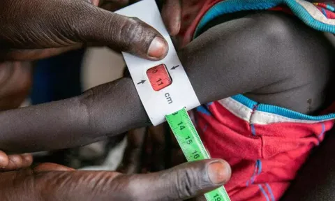 Malnutrition (Photo: Reuters)