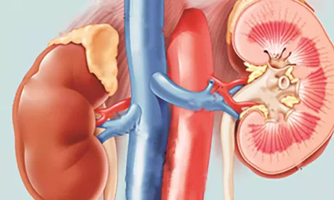 Nephrologists have underlined the need to take various measures to safeguard the community from the ill effects of the irrational use of antibiotics. (IANS)&nbsp;