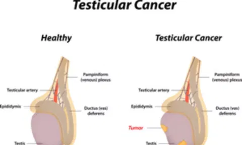 Testicular Cancer details (IANS)