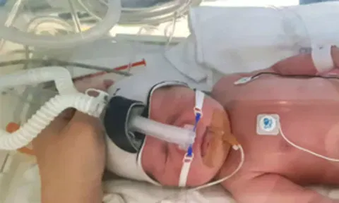 continuous positive airway pressure (CPAP) (IANS)