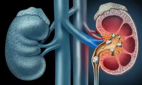 Robotic surgery for kidney cancer shows desirable outcomes: Doctor