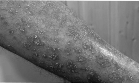 Skin cancer surges worldwide in older men in last 30 years: Study