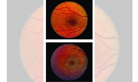 Vision loss caused by a blinding eye disease can be slowed with surgical implant (IANS)
