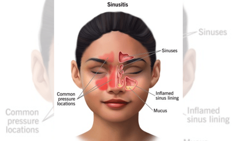 Surgery more effective in treating chronic sinus (IANS)