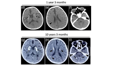 Indian researchers find rare gene mutation linked to recurrent neurological decline in kids