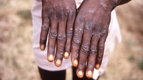 No Monkeypox case reported in Mumbai so far: BMC