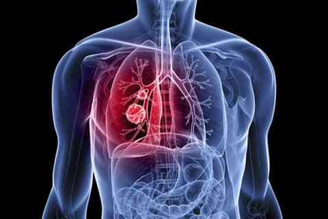 Coronavirus' spike protein alone may cause lung damage: Study