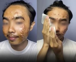 Viral Video: TikToker claims unwashed thrifted clothes triggered rare skin infection