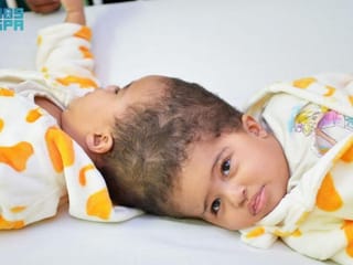 Eritrean twins separated after 15-hour surgery at Saudi children’s hospital