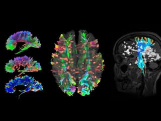 Abu Dhabi researchers create AI tool for faster multiple sclerosis diagnosis