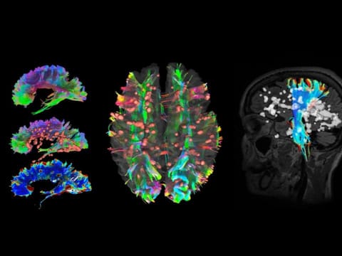 Abu Dhabi researchers create AI tool for faster multiple sclerosis diagnosis