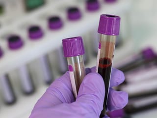 Breakthrough in organ transplants: Scientists convert blood type in kidney  