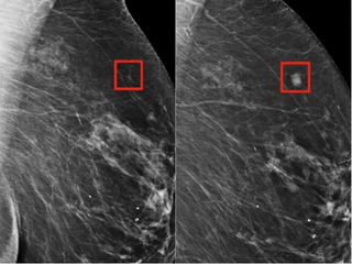 AI helps doctors spot breast cancer in scans: world-first trial