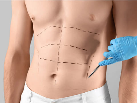 How modern abdominoplasty is solving chronic back pain by repairing core muscle damage
