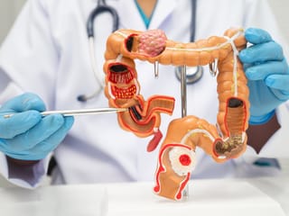 Why incidence of colorectal cancer is rising 
