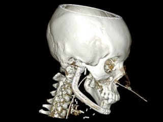 PRIME Hospital performs complex jaw reconstruction